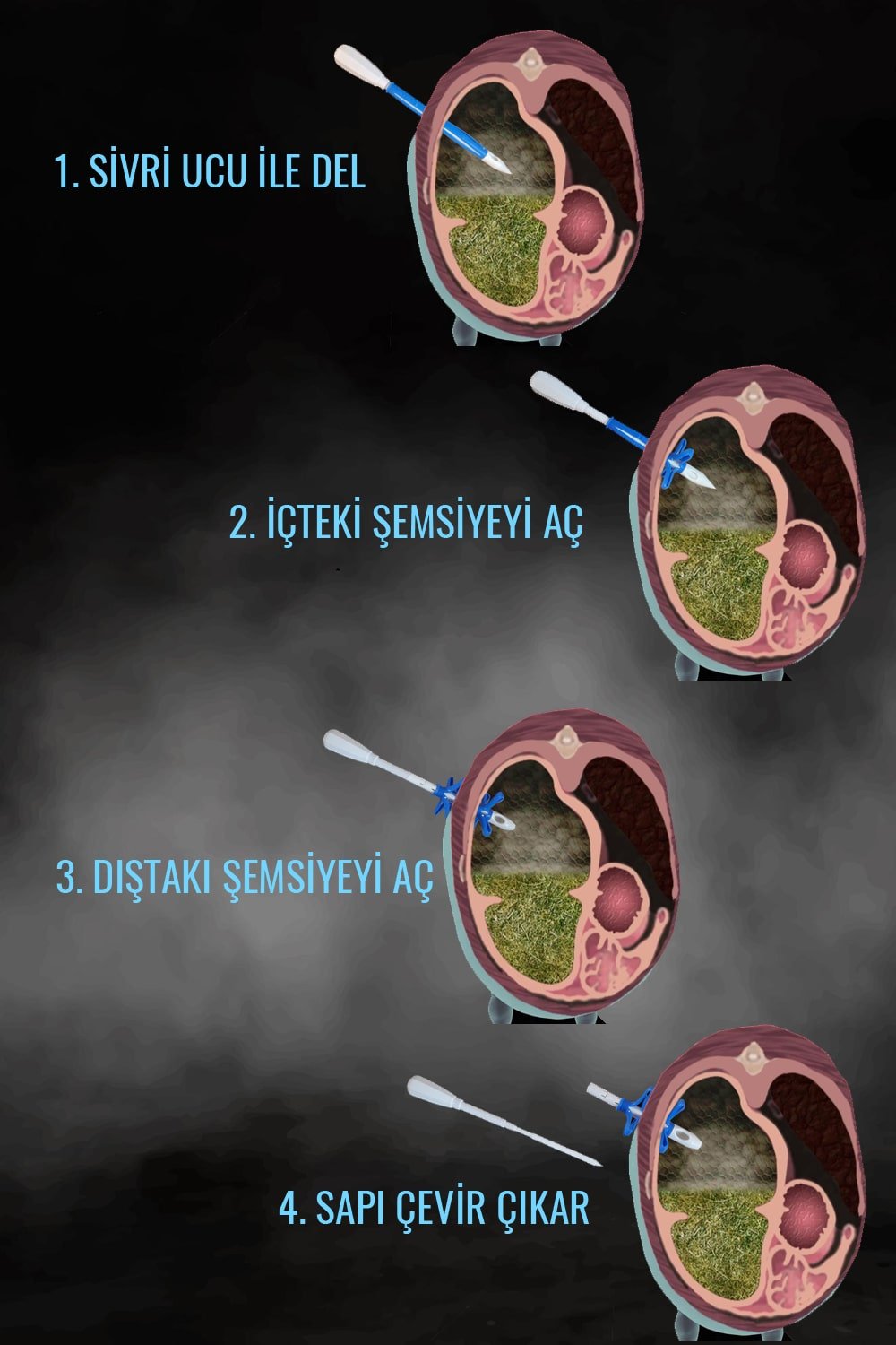 Şemsiye Trokar Nasıl Kullanılır?